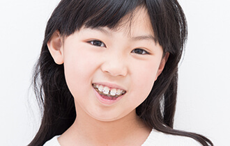 第1期治療（発育期矯正）※子どもの治療のみ